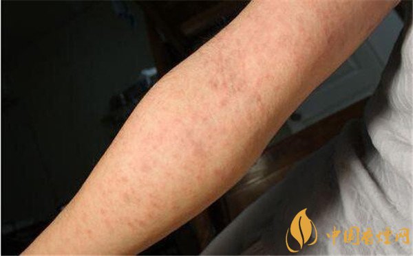 戒煙藥暢沛副作用有哪些 戒煙藥暢沛對人體的危害(有自殺風險)